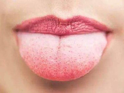 舌苔这种颜色竟是患癌初期前兆