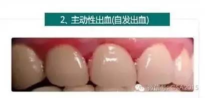牙龈流血找不出原因？专业牙医解说！