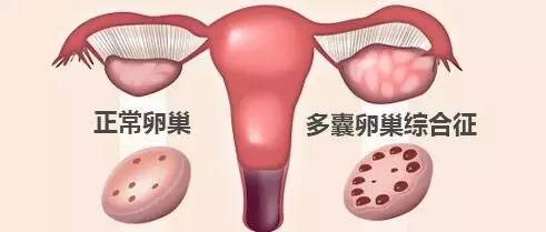 别小看多囊卵巢综合征！