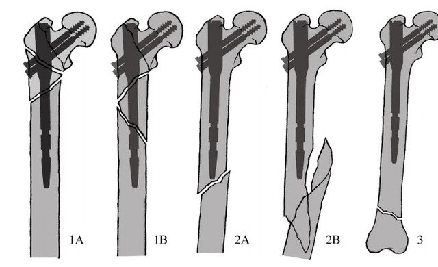 这些股骨转子间骨折 短髓内钉远端应常规锁定