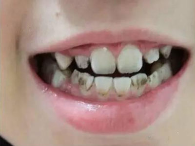 会把你的口腔中的残渣消化成酸性物质,当这些酸性物质聚集在牙齿表面