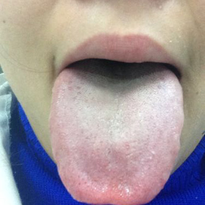 如何保养身体 舌苔厚黄是什么引起的呢? 