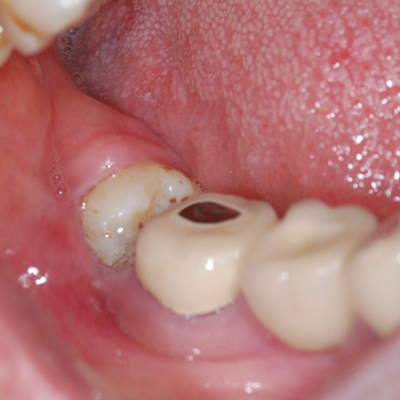 5,智齿周围囊性病变