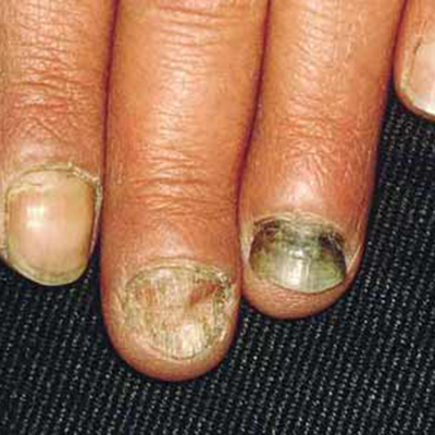 肺癌早期症状指甲图片图片