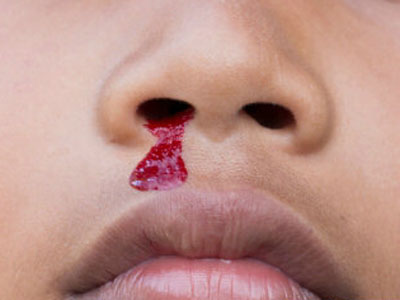 很多家长看到孩子的鼻子出血就会很紧张